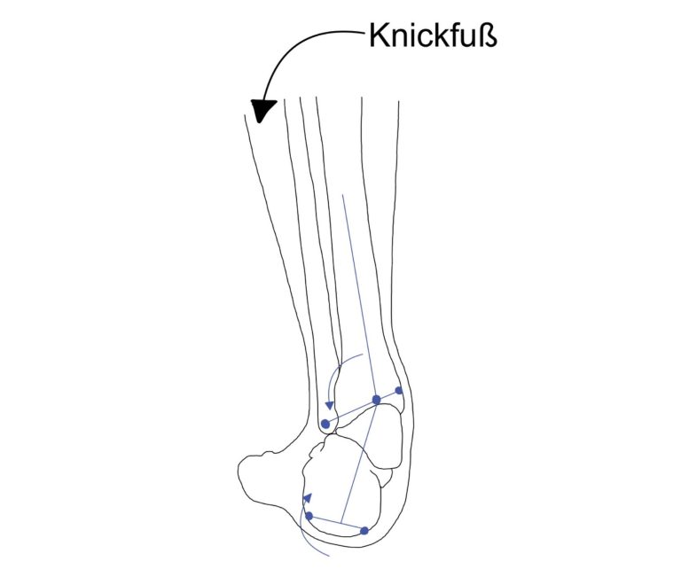 Knick-, Senkfuß