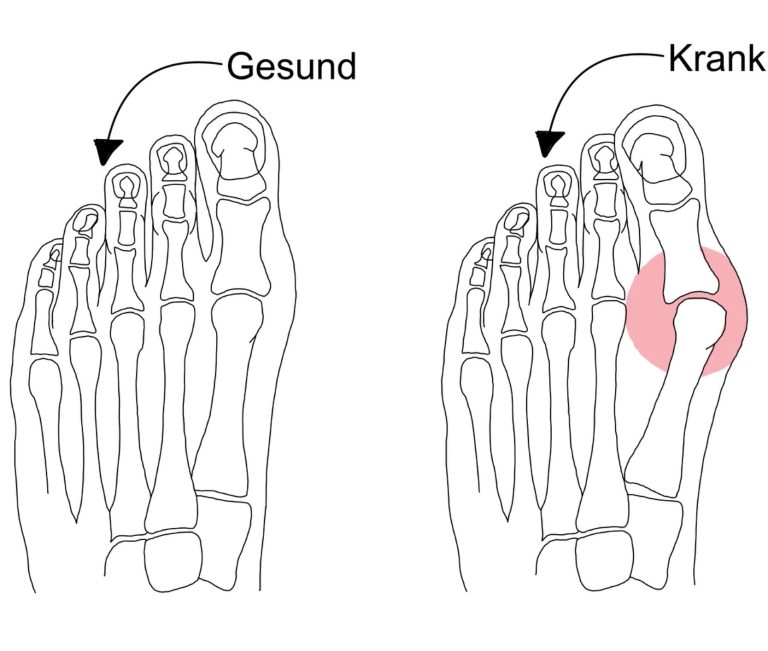 Hallux valgus