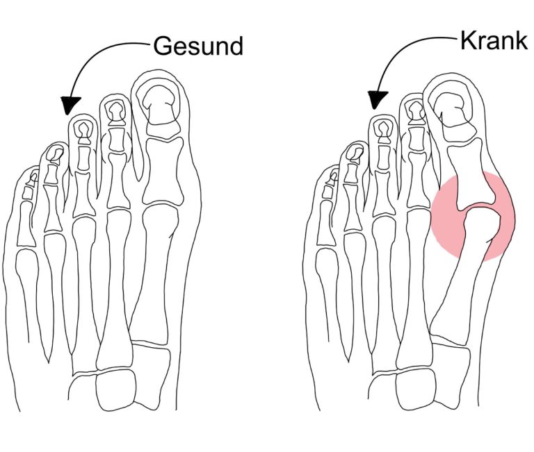 Hallux valgus