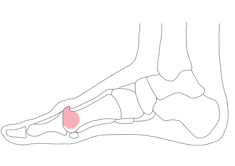 Hallux valgus