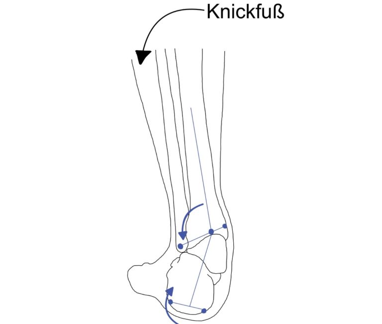 Knick-, Senkfuß