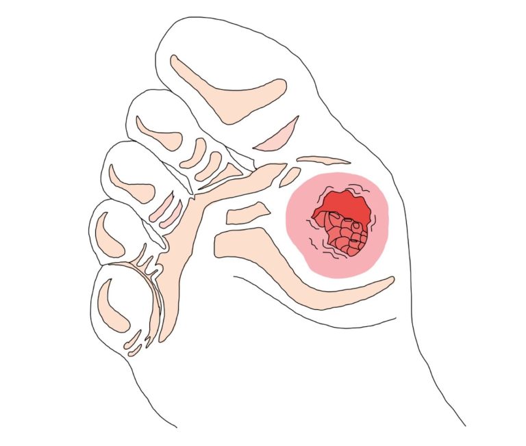 Hallux valgus