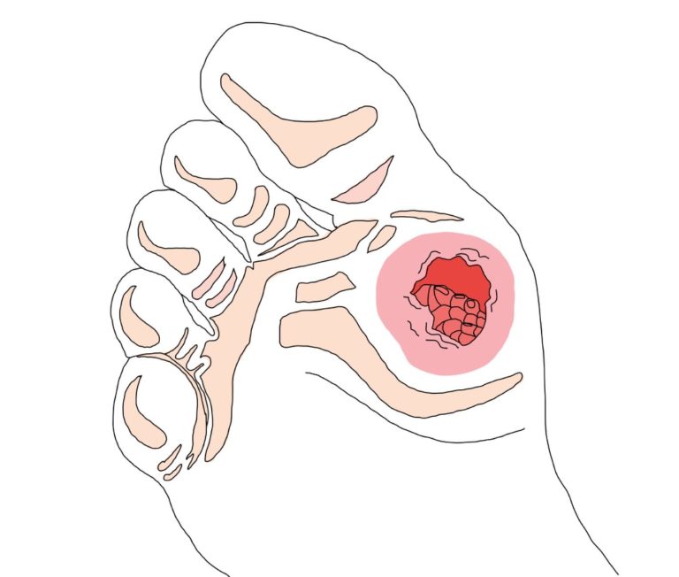 Hallux valgus