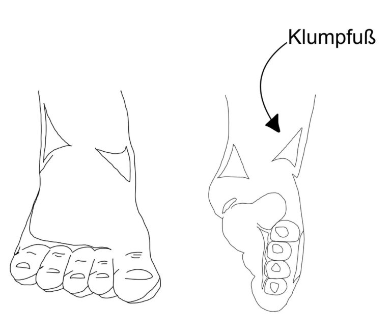 Spreizfuß