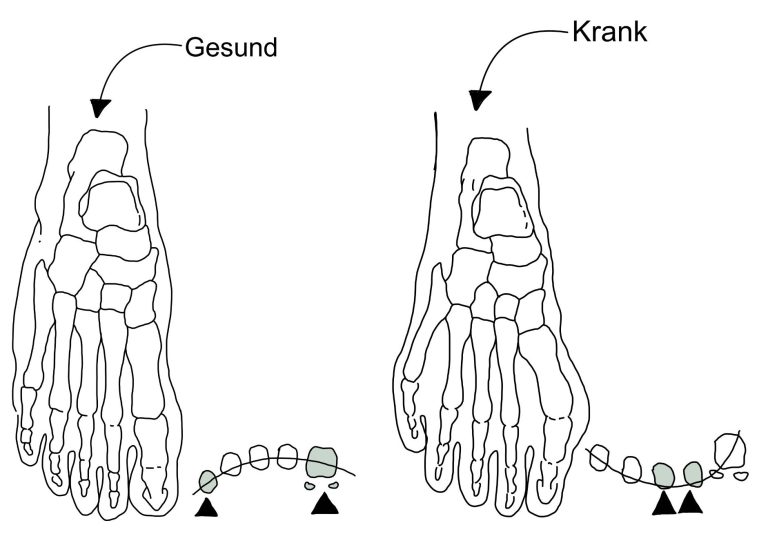 Spreizfuß