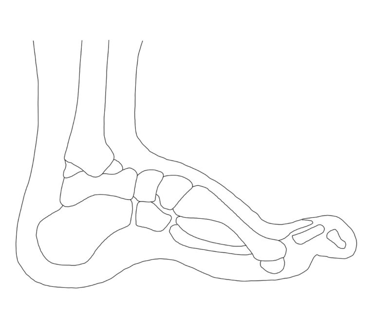 Hallux valgus