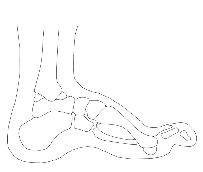 Hallux valgus